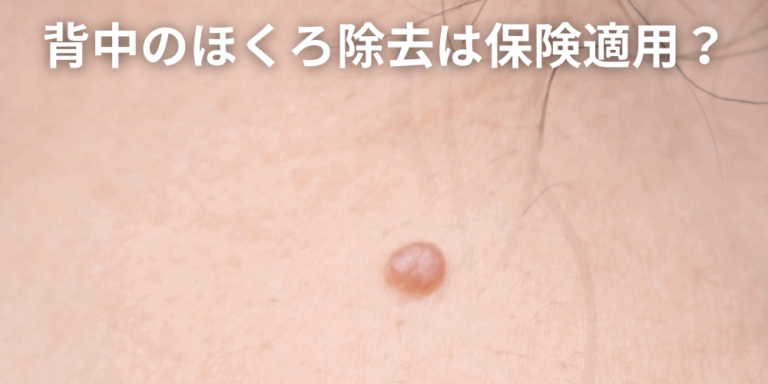ほくろと間違えやすい皮膚がん｜悪性黒色腫（メラノーマ）の見分け方！