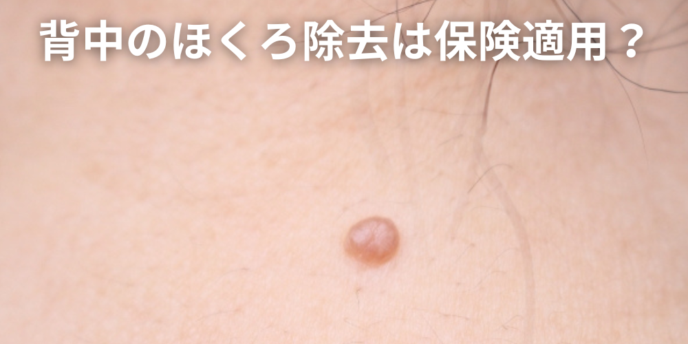 ほくろを触ると痛いのは危険？原因と悪性腫瘍との違い、受診の目安を解説 - 東京皮膚腫瘍ほくろと粉瘤クリニック 古林形成外科上野院