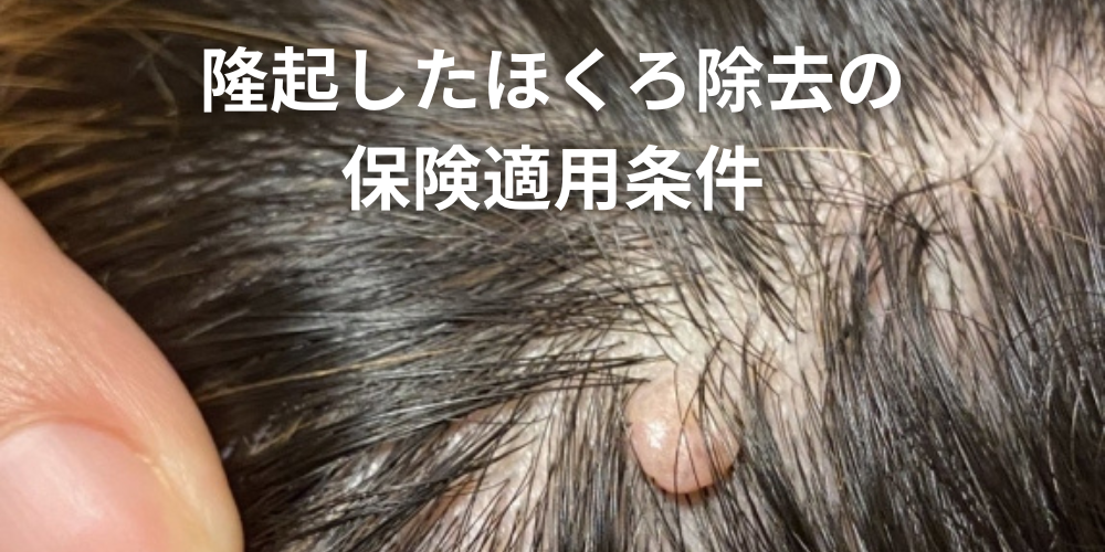 ほくろと皮膚がんの見分け方｜注意すべき5つのポイントを解説！