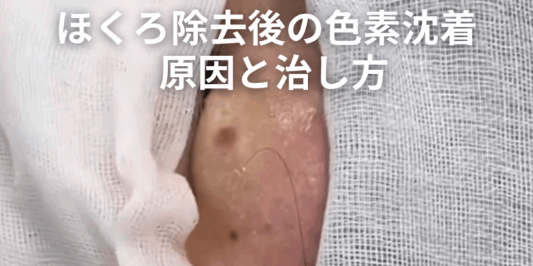 ほくろと間違えやすい皮膚がん｜悪性黒色腫（メラノーマ）の見分け方！