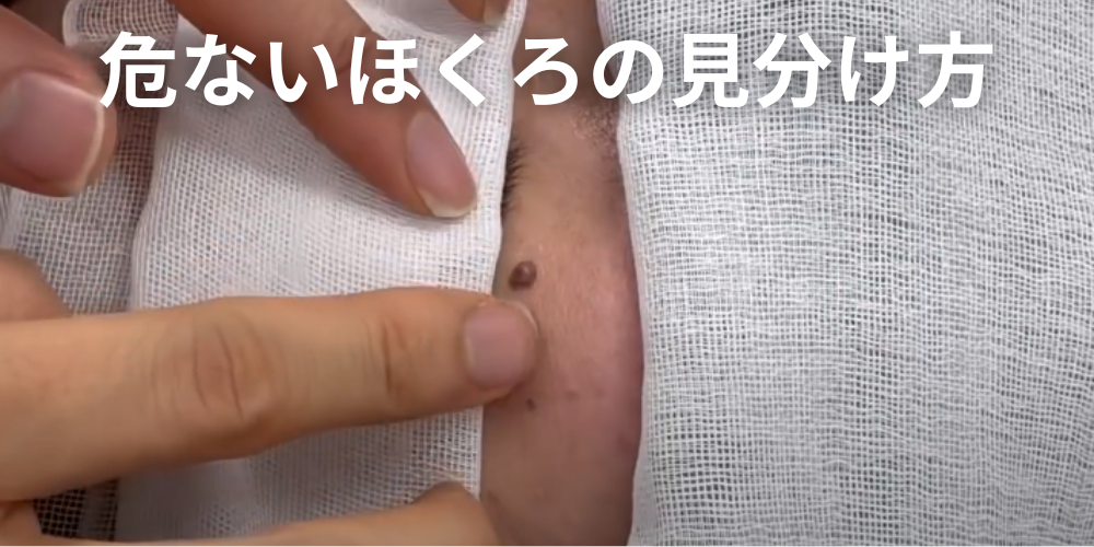 ほくろと間違えやすい皮膚がん|悪性黒色腫(メラノーマ)の見分け方!