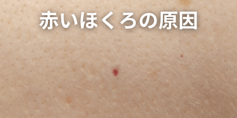 ほくろと間違えやすい皮膚がん｜悪性黒色腫（メラノーマ）の見分け方！