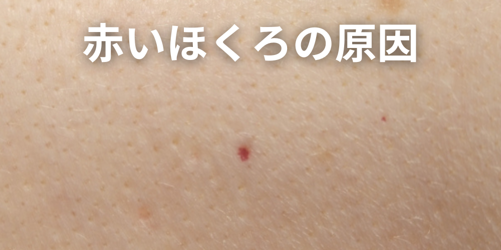 ほくろを触ると痛いのは危険？原因と悪性腫瘍との違い、受診の目安を解説 - 東京皮膚腫瘍ほくろと粉瘤クリニック 古林形成外科上野院