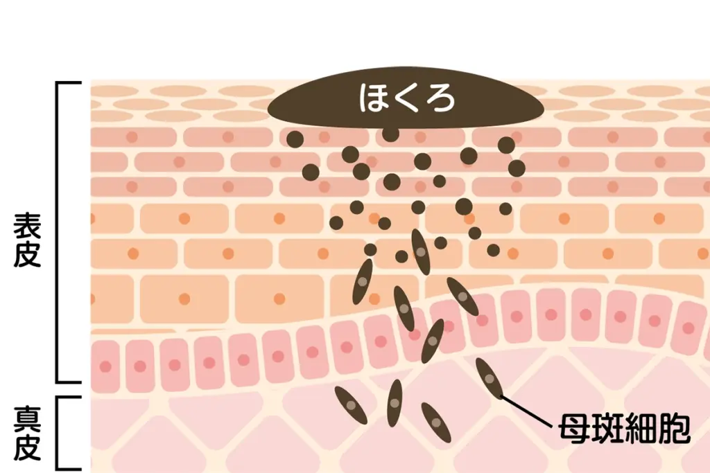 ほくろの原因