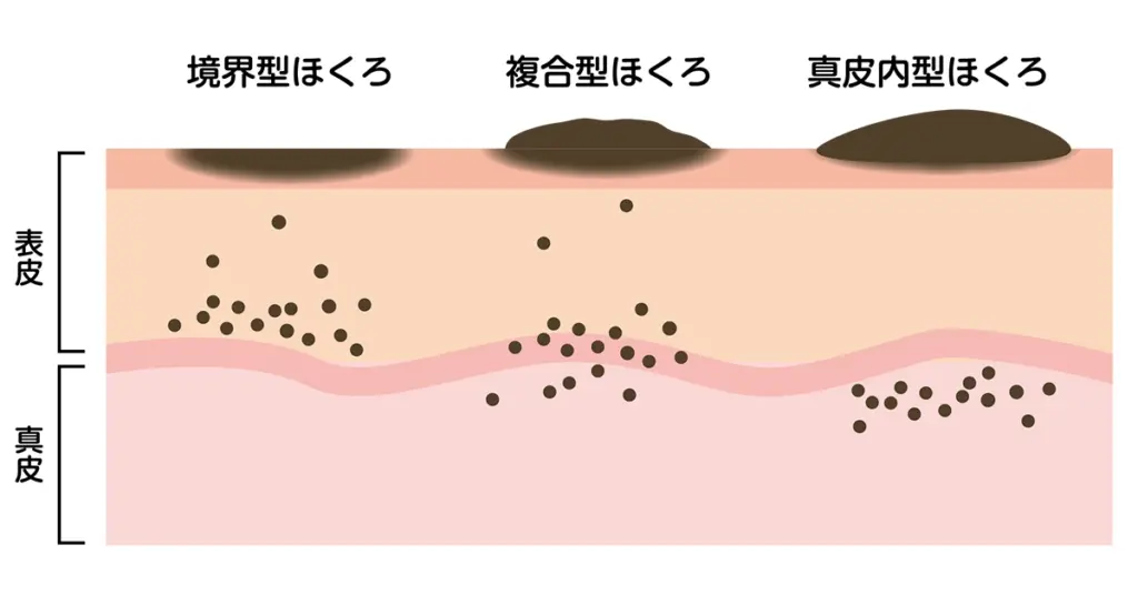 ほくろの分類