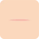 抜糸