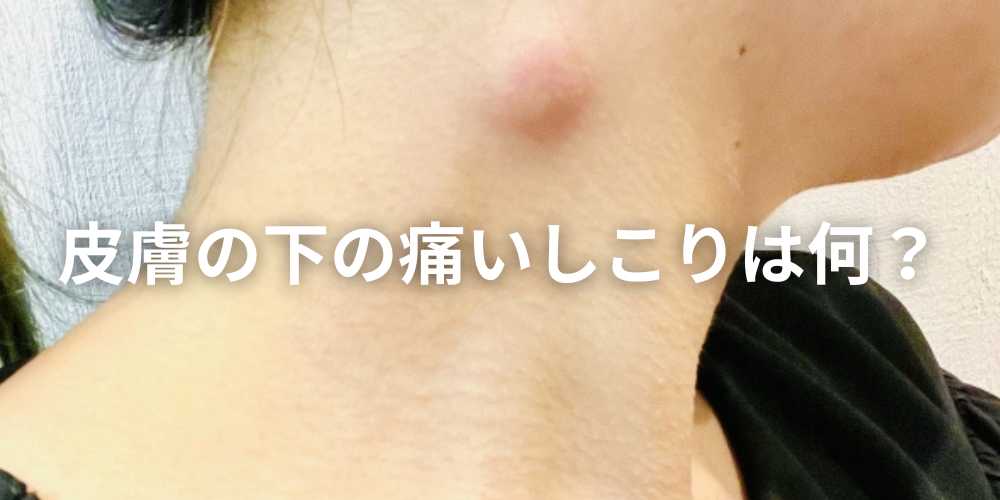 太ももの外側に“押すと痛いしこり”ができたら?原因と受診すべき診療科を形成外科が解説 - 東京皮膚腫瘍ほくろと粉瘤クリニック 古林形成外科上野院