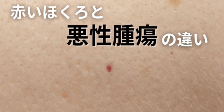 赤いほくろは大丈夫?悪性腫瘍(メラノーマ・基底細胞癌)との違いと見分け方 - 東京皮膚腫瘍ほくろと粉瘤クリニック 古林形成外科上野院