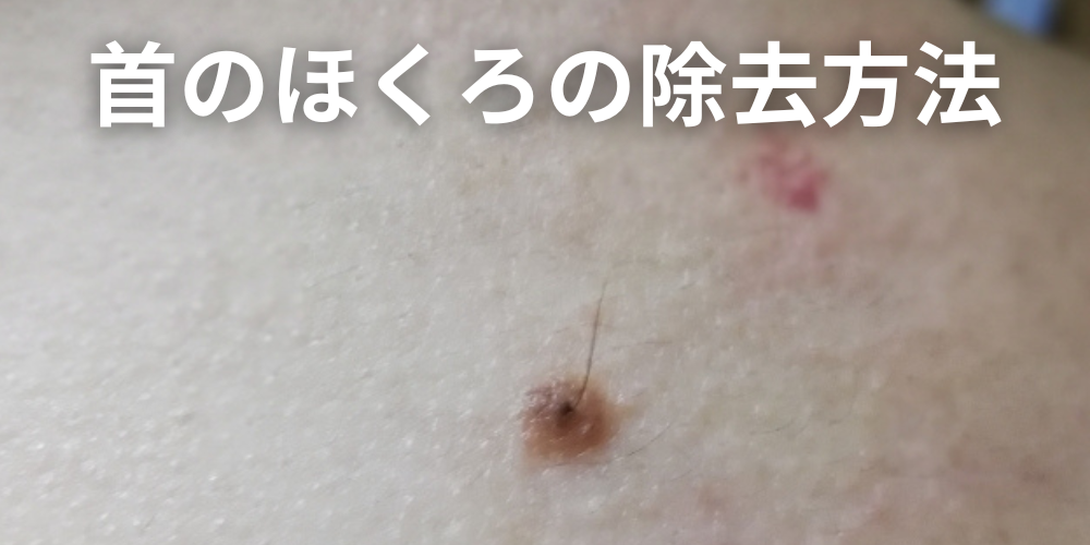ほくろを触ると痛いのは危険？原因と悪性腫瘍との違い、受診の目安を解説 - 東京皮膚腫瘍ほくろと粉瘤クリニック 古林形成外科上野院