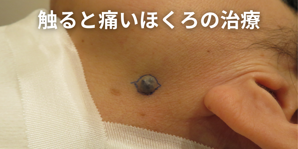 ほくろ除去は切開とレーザーどっちがいい？違いと選び方を解説 - 東京皮膚腫瘍ほくろと粉瘤クリニック 古林形成外科上野院