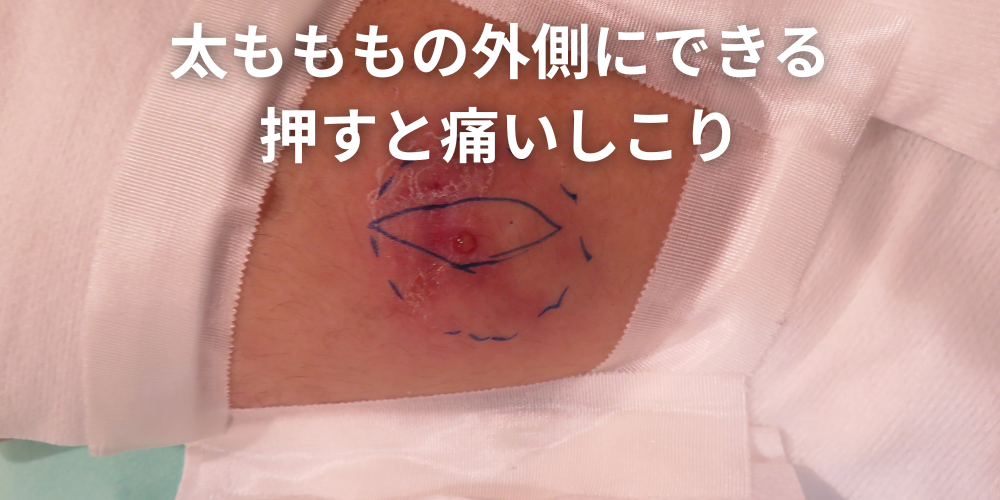 治らないできもののしこりは何?考えられる病気と受診の目安・何科に行くべきかを解説 - 東京皮膚腫瘍ほくろと粉瘤クリニック 古林形成外科上野院