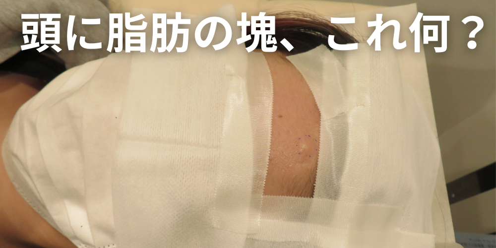 治らないできもののしこりは何?考えられる病気と受診の目安・何科に行くべきかを解説 - 東京皮膚腫瘍ほくろと粉瘤クリニック 古林形成外科上野院